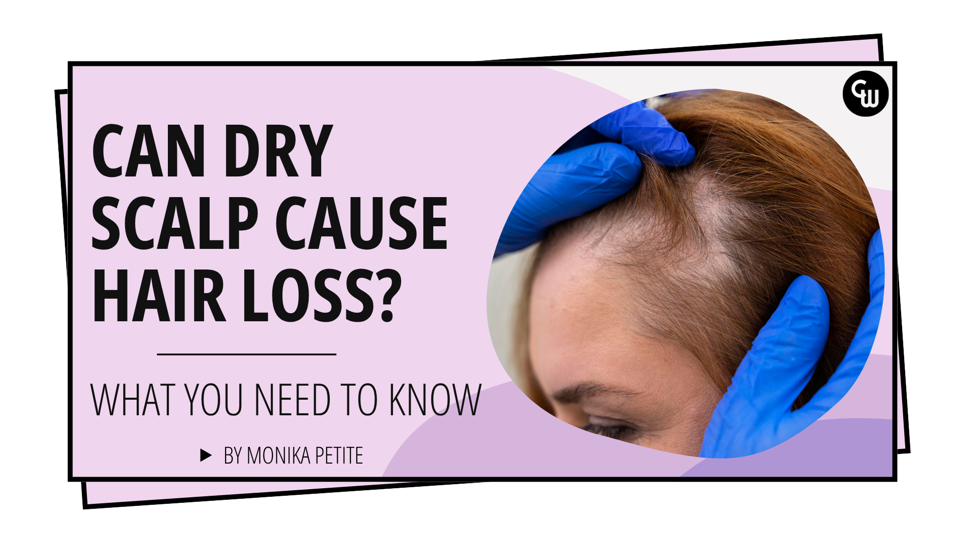 Can Dry Scalp Cause Hair Loss?