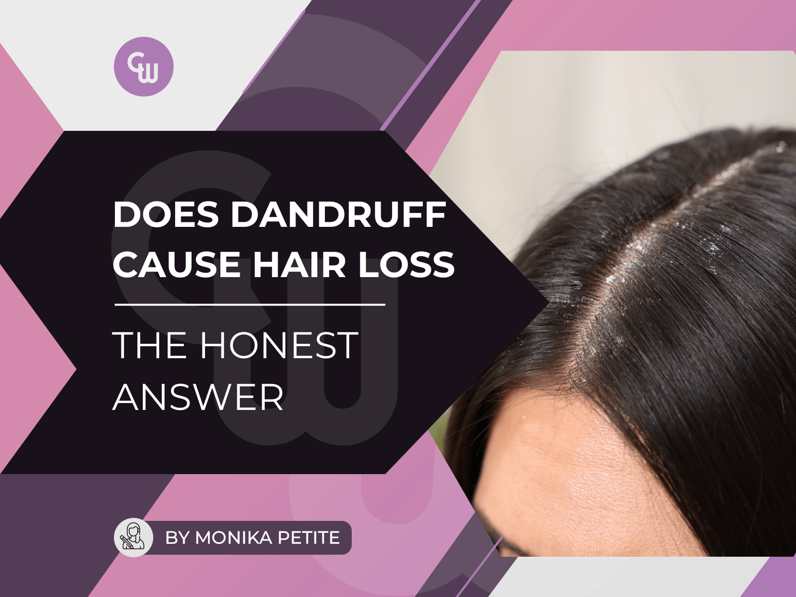 Does Dandruff Cause Hair Loss? The Honest Answer - Cosmetic World